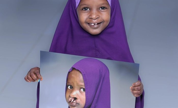 African girl in Camerron with successful cleft lip surgery smiles, in purple hijab, in Cameroon, Africa