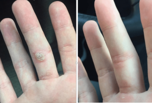 Thermavein treatment before and after on hand