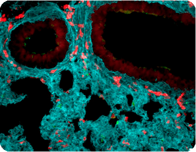 Una investigación redefine el papel de los neutrófilos y abre nuevas vías para terapias contra el cáncer y la inflamación