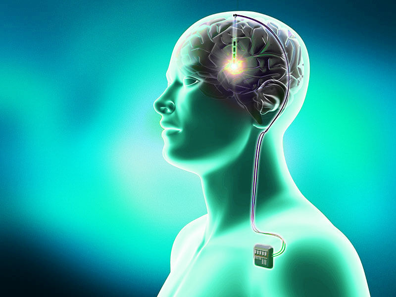 deep-brain-stimulation-parkinson’s-disease deep-brain-stimulation-parkinson's-disease