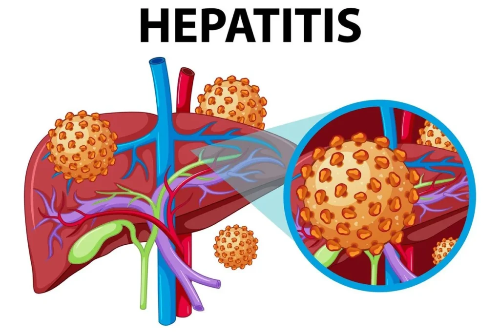 soal ukom hepatitis