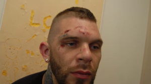 Closeup of Cody Marley's injuries