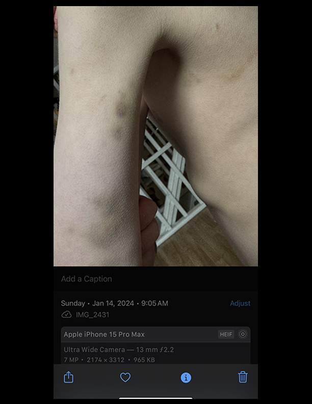 A photo shows bruising on an arm