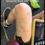 leg bruising in photo