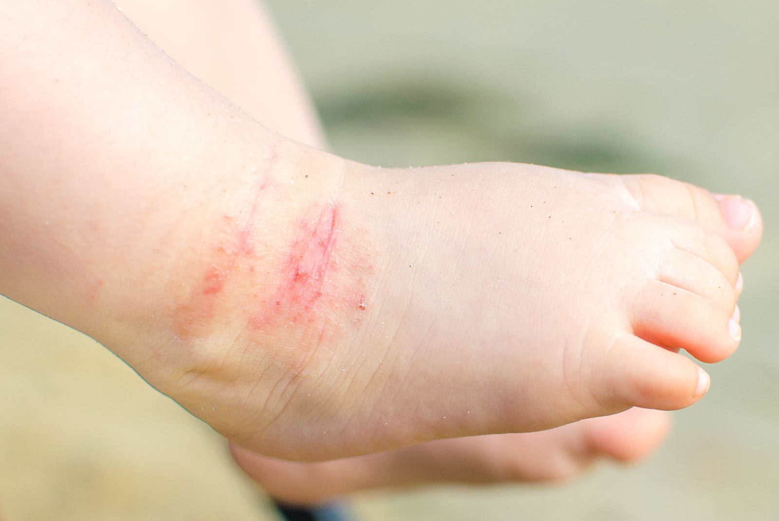 抓到見血、癢得睡不著 異位性皮膚炎怎麼辦？類固醇外，還有其他選擇｜天下雜誌