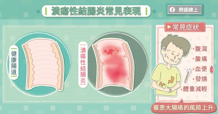 潰瘍性結腸炎常見表現