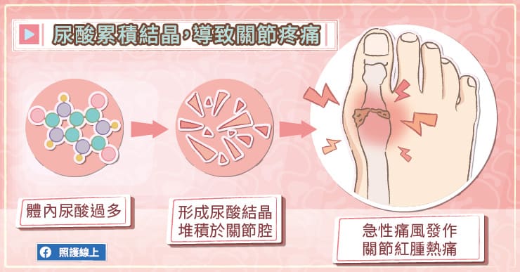 尿酸累積結晶,導致關節疼痛