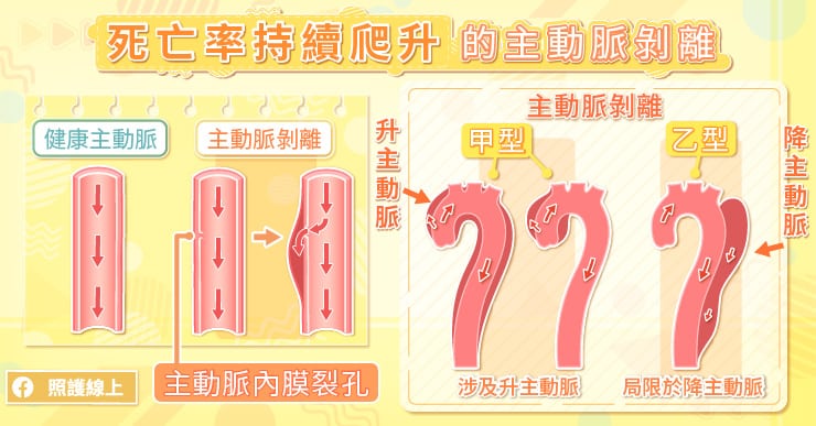 死亡率持續爬升的主動脈剝離