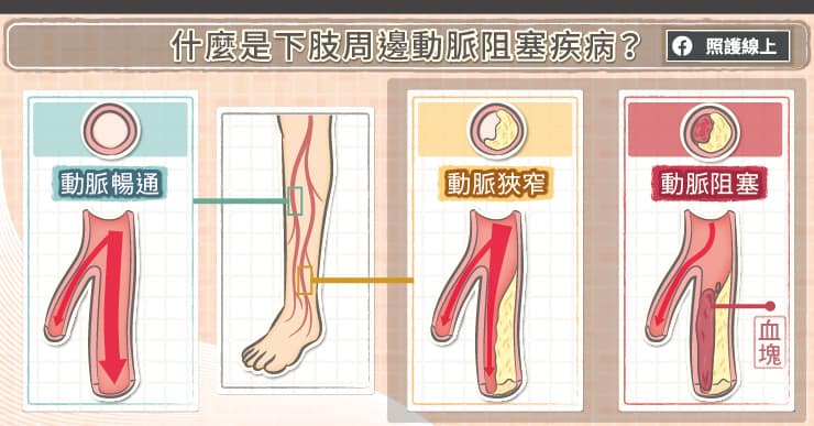 什麼是下肢周邊動脈阻塞疾病?