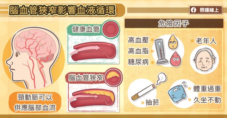 腦血管狹窄影響血液循環