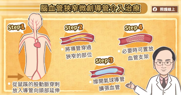 腦血管狹窄微創導管介入治療