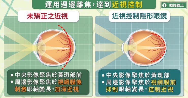 運用周邊離焦達到近視控制