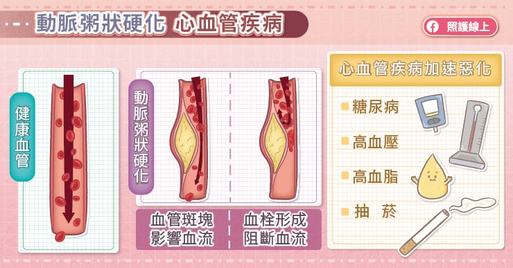 什麼是動脈粥狀硬化心血管疾病?