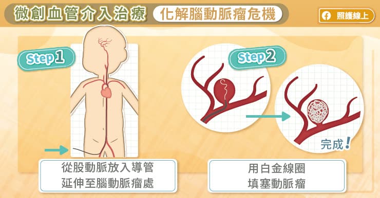 微創血管介入治療,化解腦動脈瘤危機