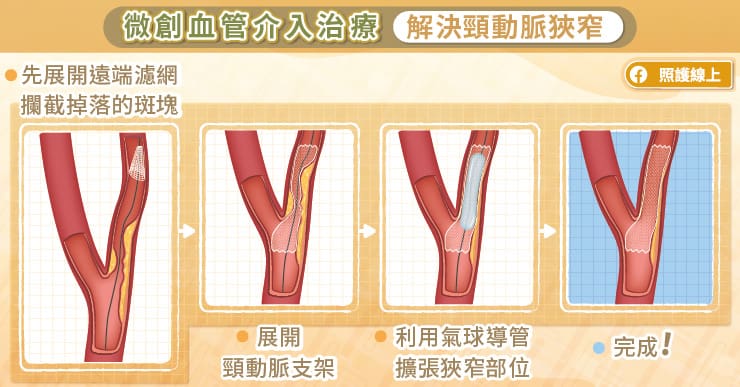 微創血管介入治療解決頸動脈狹窄