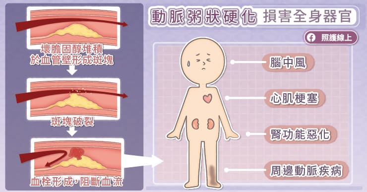 動脈粥狀硬化損害全身器官