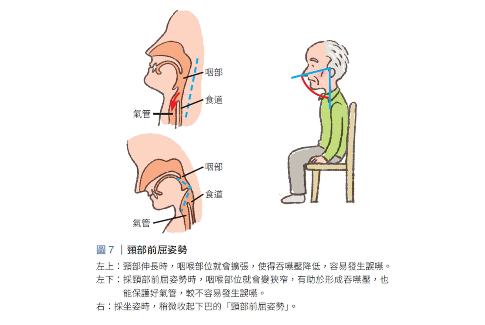 照顧心法 吸入性肺炎 嗆到 吞嚥 誤嚥
