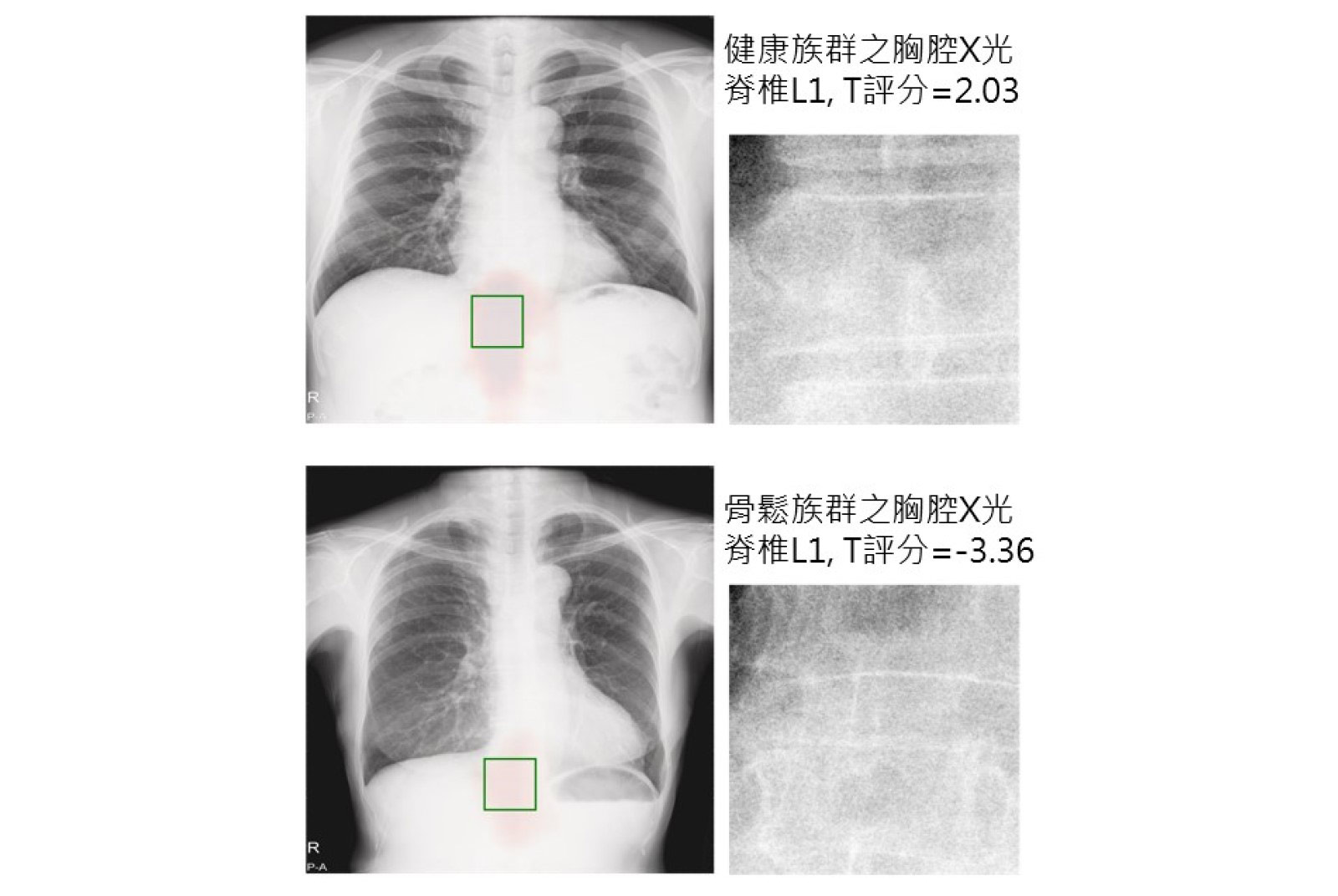 智慧醫療 骨質疏鬆症 老人跌倒 DXA 長庚醫院 AI影像分析 深度學習技術