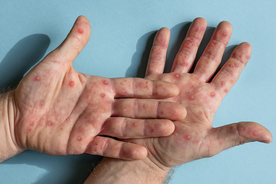 dermatitis atópica qué es