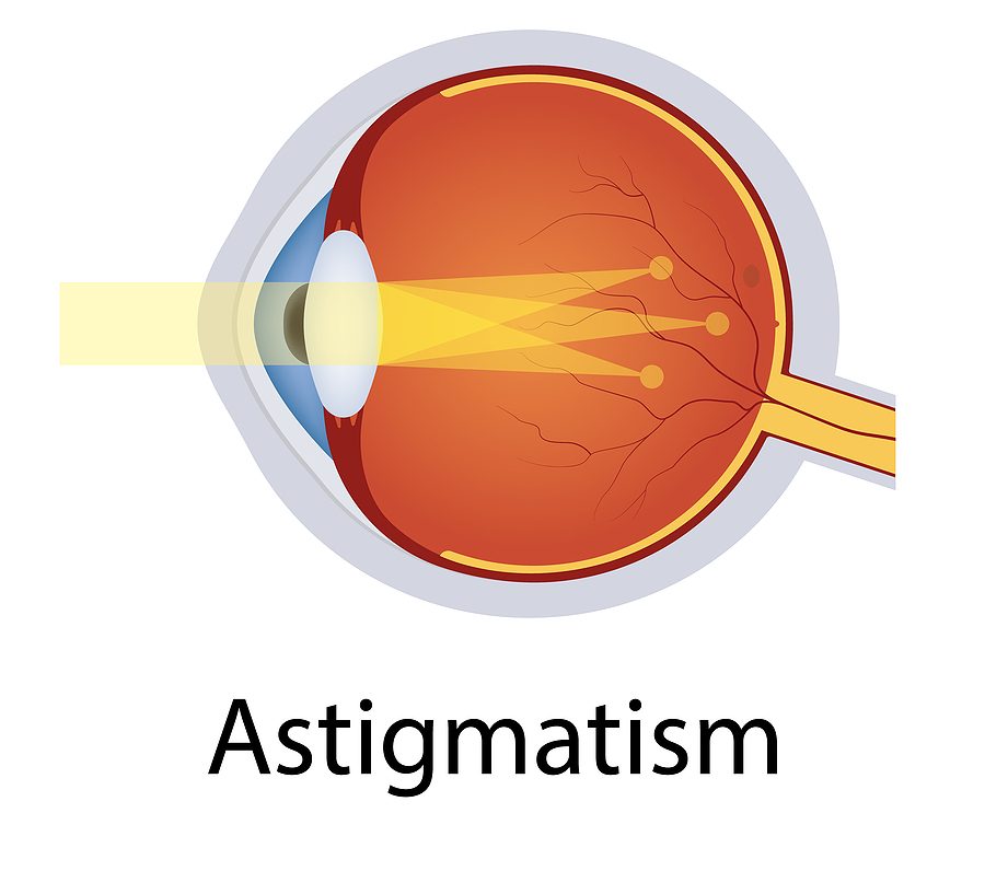 astigmatismo