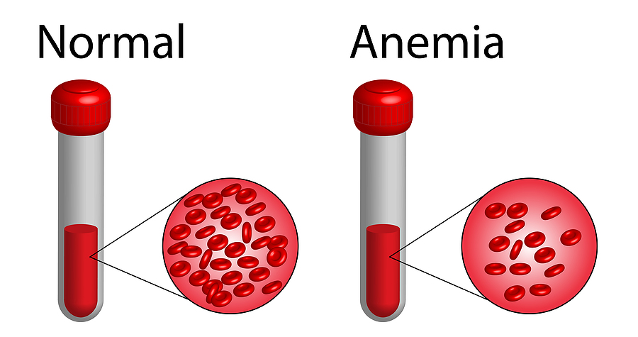 síntomas anemia