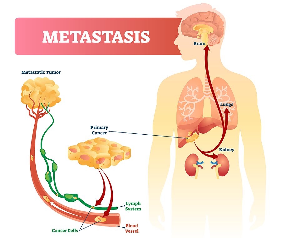 células metástasis cáncer