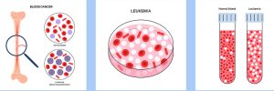 Tipos leucemia