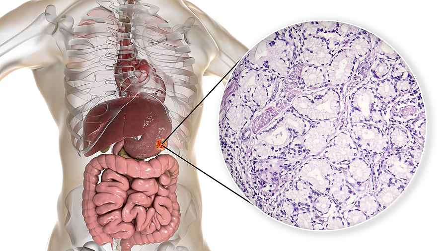 ¿Detectar el cáncer gástrico es posible?