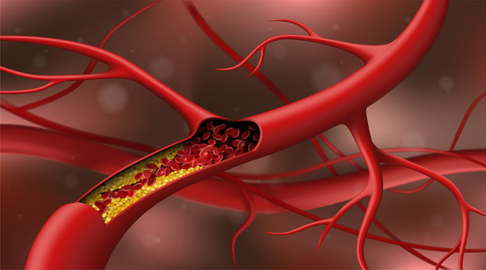 ¿Es posible controlar la esclerosis múltiple?