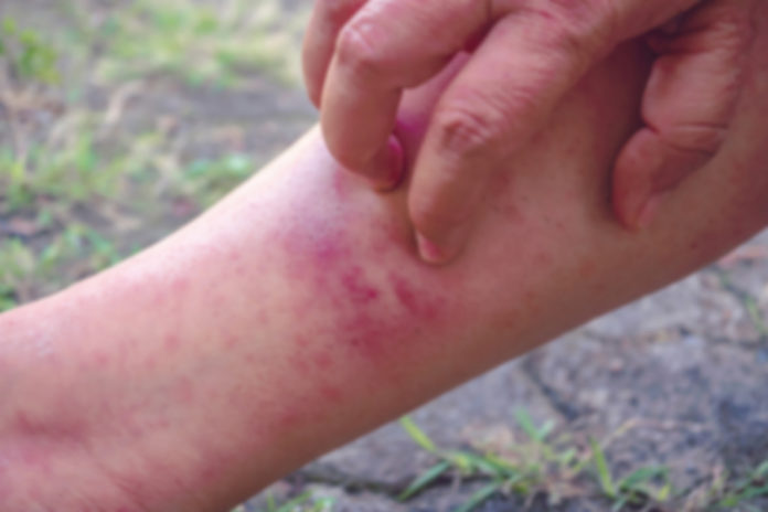 dermatitis atópica en niños