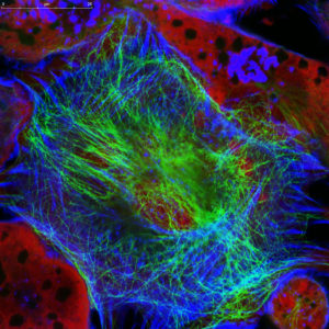 El Neuroblastoma afecta especialmente a los infantes