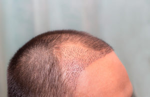 Patologías que afectan el cabello y como enfrentarlas