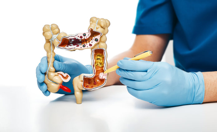 El colon: Enfermedades y la Importancia de cuidarlo