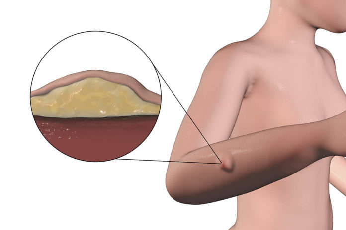 ¿Un lipoma puede ser peligrosos para la salud?