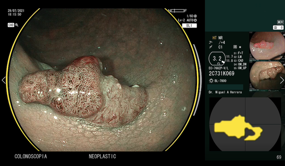 endoscopia