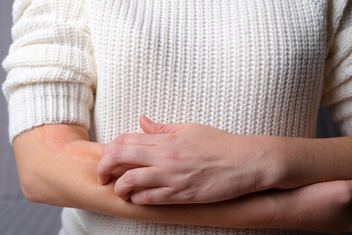 5 consejos para mantener la dermatitis atópica bajo control