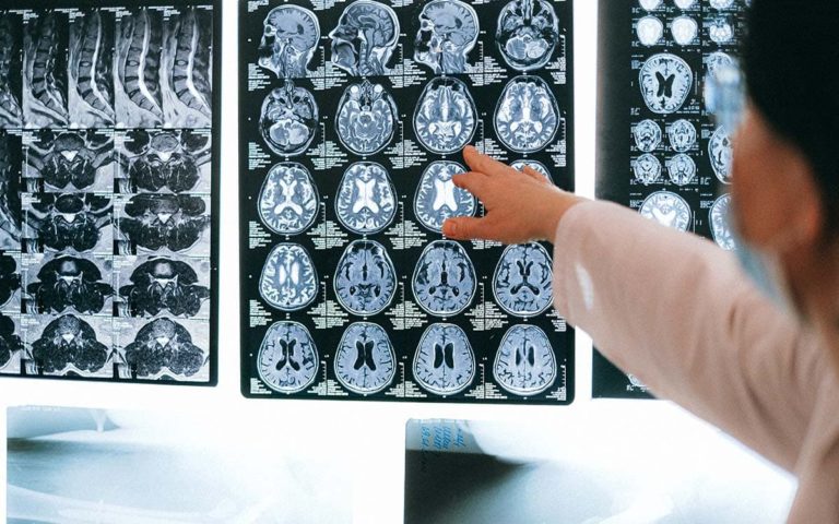 Primer escaneo del cerebro humano muriendo muestra resultados asombrosos