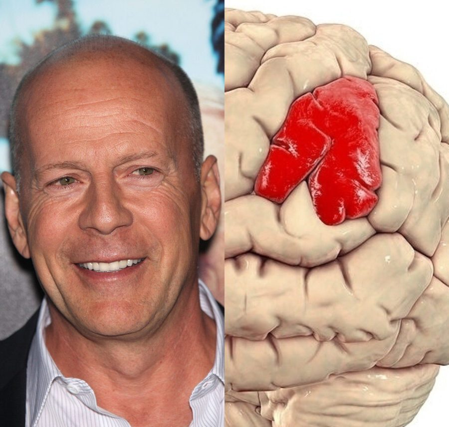 La demencia frontotemporal, el padecimiento que sufre Bruce Willis