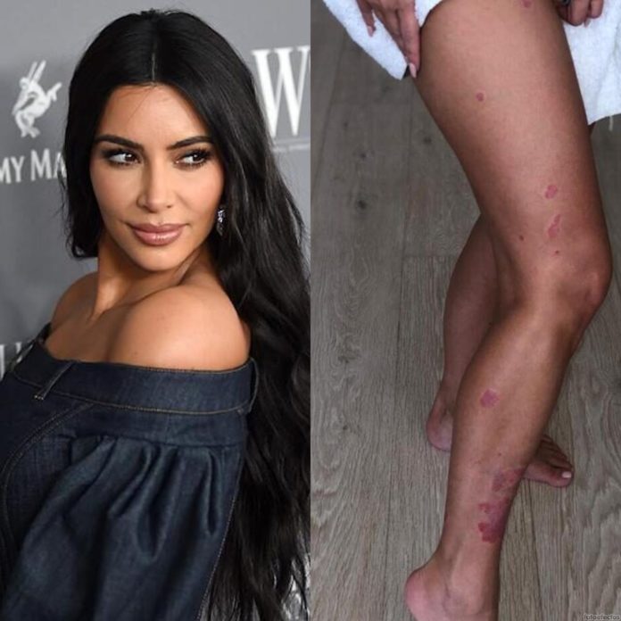 Kim Kardashian psoriasis