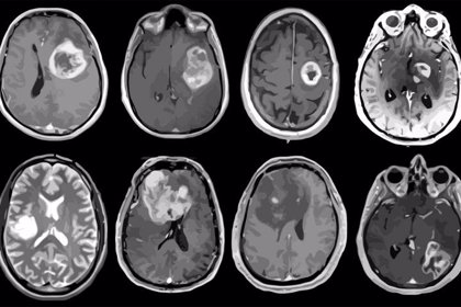 prueba cáncer tumores raros