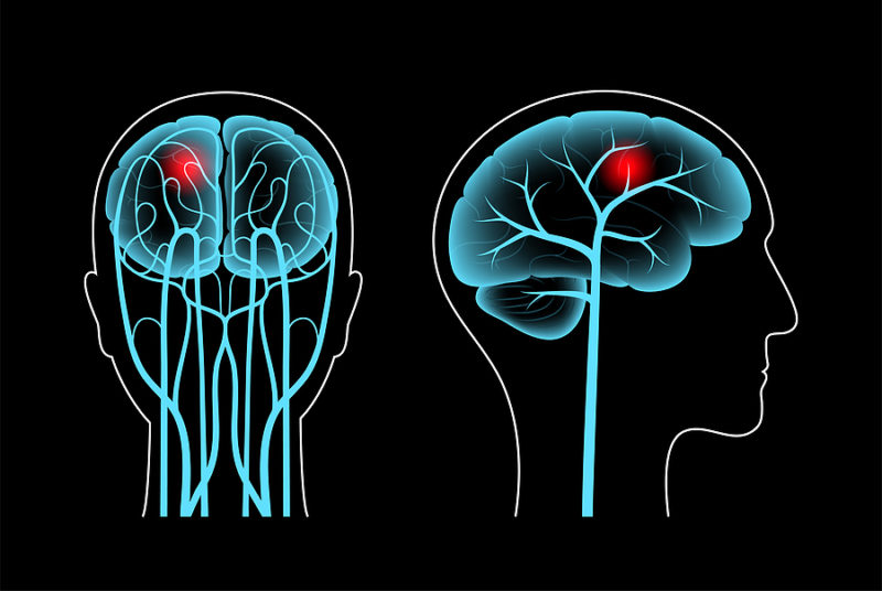 Infarto cerebral curiosidades