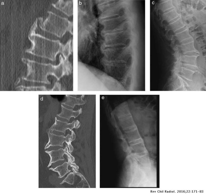 espondilitis anquilosante