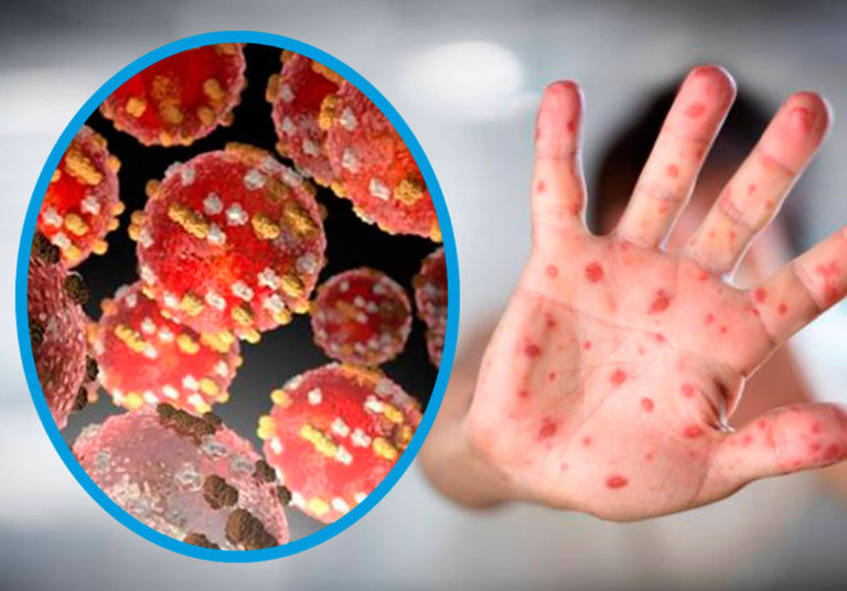 Posibles medicamentos que podrían funcionar contra la viruela del mono