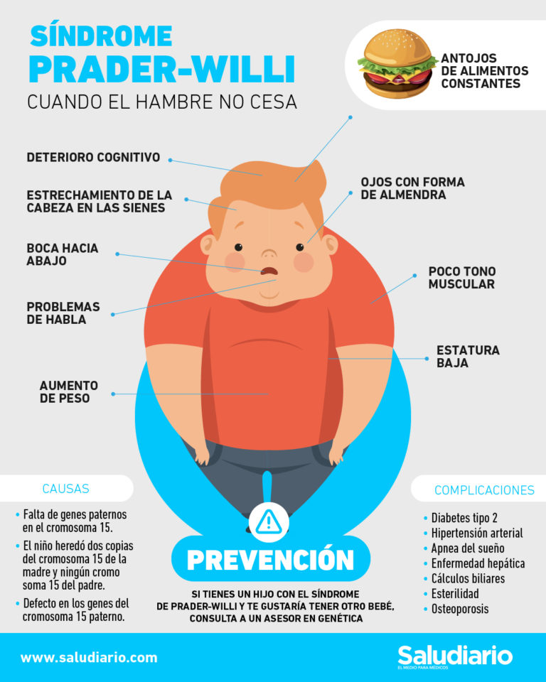 Síndrome de Prader-Willi, primera causa de obesidad de origen genético
