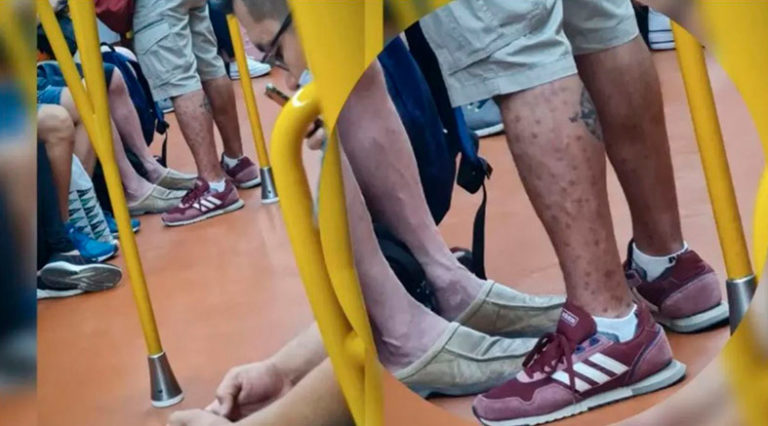 Doctor detecta la viruela del mono en el Metro y se hace viral en Twitter