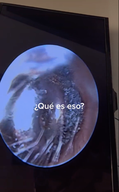 Doctor viraliza video de lo que encontró en oído de paciente