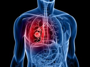 SSA: Con tamizaje es posible detectar casos de cáncer de pulmón