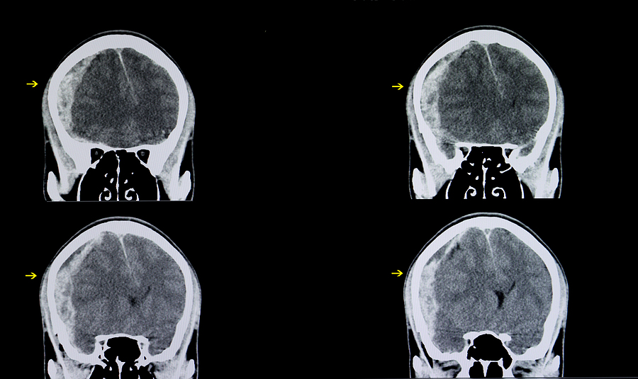 lesiones cerebrales