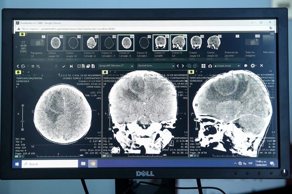 absceso cerebral