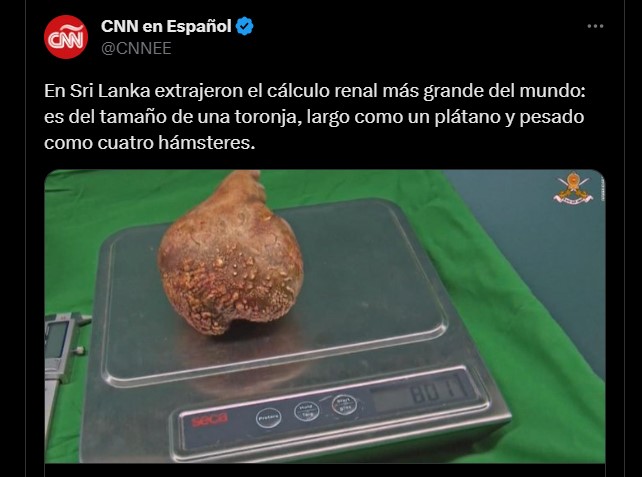 cálculo renal más grande